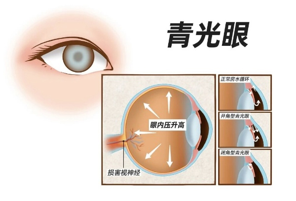 2026世界青光眼周——警惕各类青光眼！早筛早控守护光明