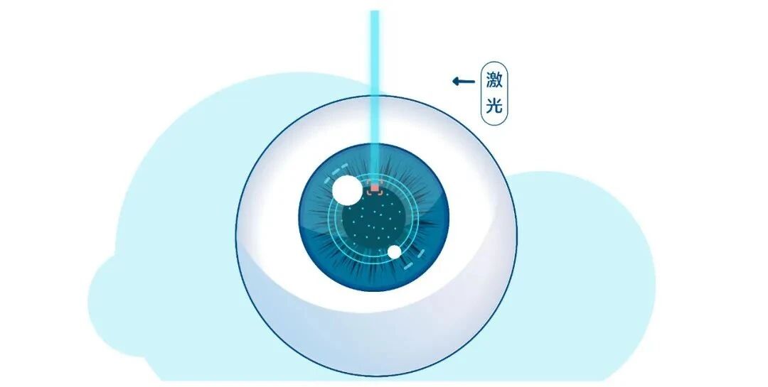 近视手术选择指南：如何找到最适合你的矫正方案
